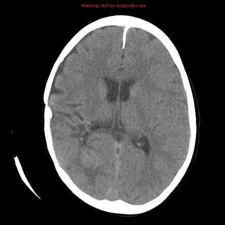 Choroid plexus carcinoma: recurrent | Radiology Case | Radiopaedia.org