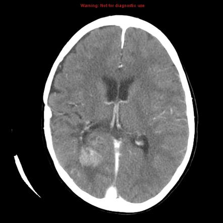 Choroid plexus carcinoma: recurrent | Image | Radiopaedia.org