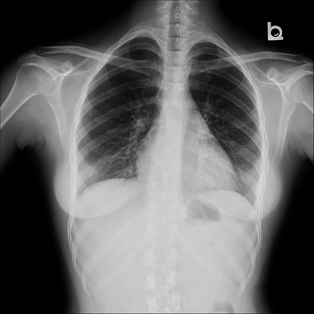 Lymphocytic interstitial pneumonitis | Image | Radiopaedia.org