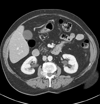 Lumbar nerve root tumor | Radiology Case | Radiopaedia.org