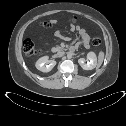 Adrenal cyst | Image | Radiopaedia.org