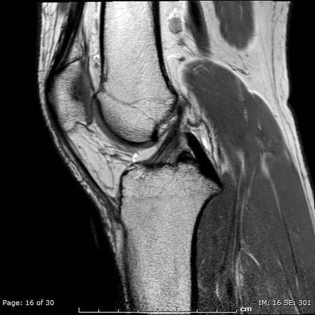 Medial collateral ligament injury: grade 1 | Image | Radiopaedia.org