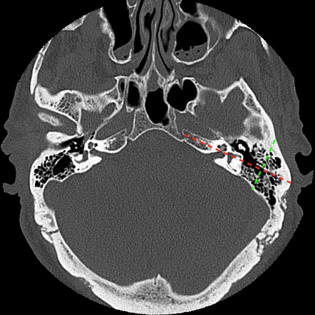 Normal Petrous Temporal Bone Ct 