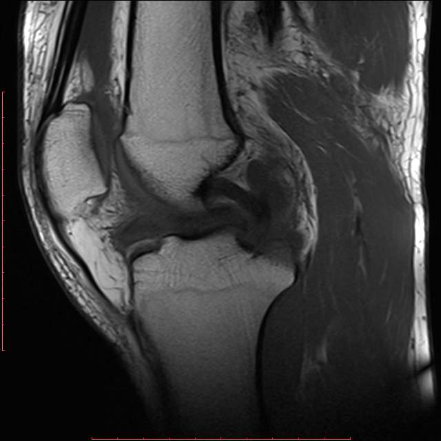 Meniscal bucket handle tear (flipped meniscus) | Image | Radiopaedia.org