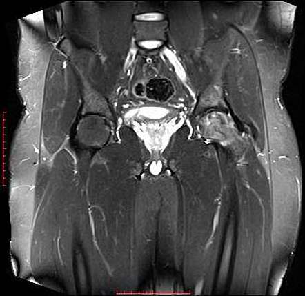 Femoral head avascular necrosis | Radiology Case | Radiopaedia.org