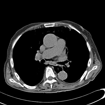 Iatrogenic esophageal perforation | Image | Radiopaedia.org