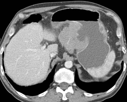 Viewing playlist: small bowel tumor | Radiopaedia.org