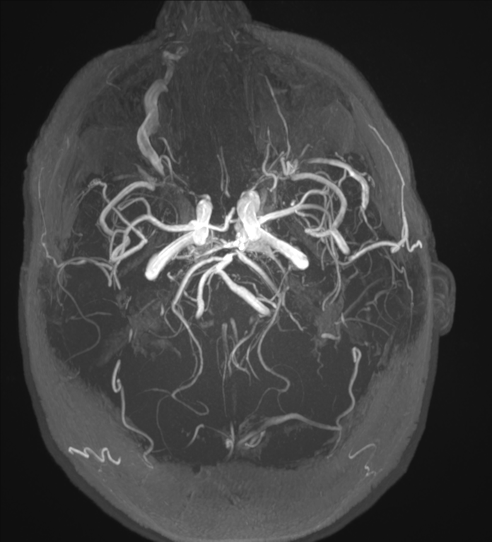 Cavernous sinus dural arteriovenous fistula | Image | Radiopaedia.org