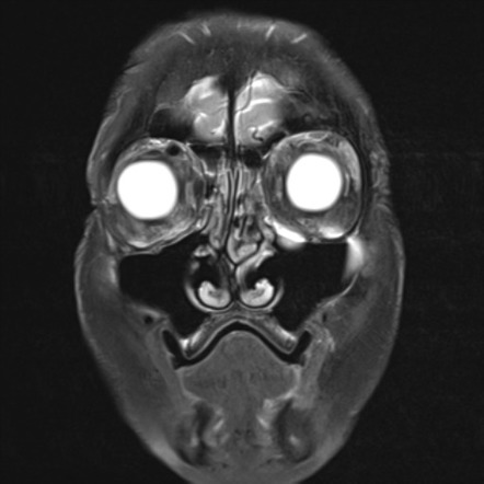 Cavernous sinus dural arteriovenous fistula | Radiology Case ...