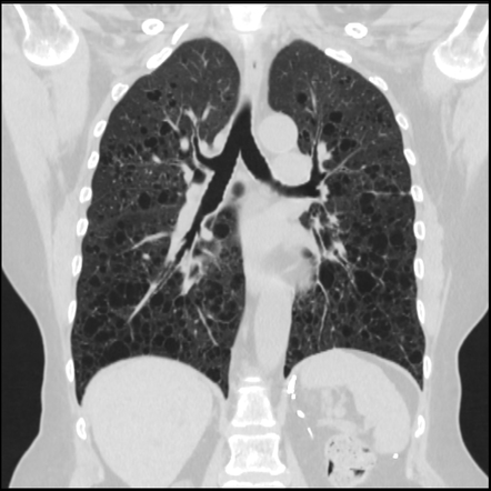 Lymphangioleiomyomatosis | Radiology Case | Radiopaedia.org