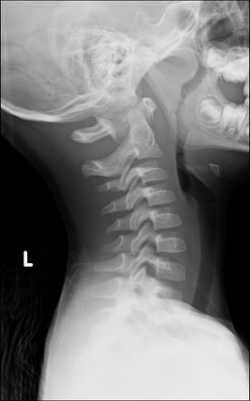 Jefferson fracture - child | Image | Radiopaedia.org