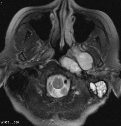 Pleomorphic Adenoma Of The Salivary Glands Radiology Reference