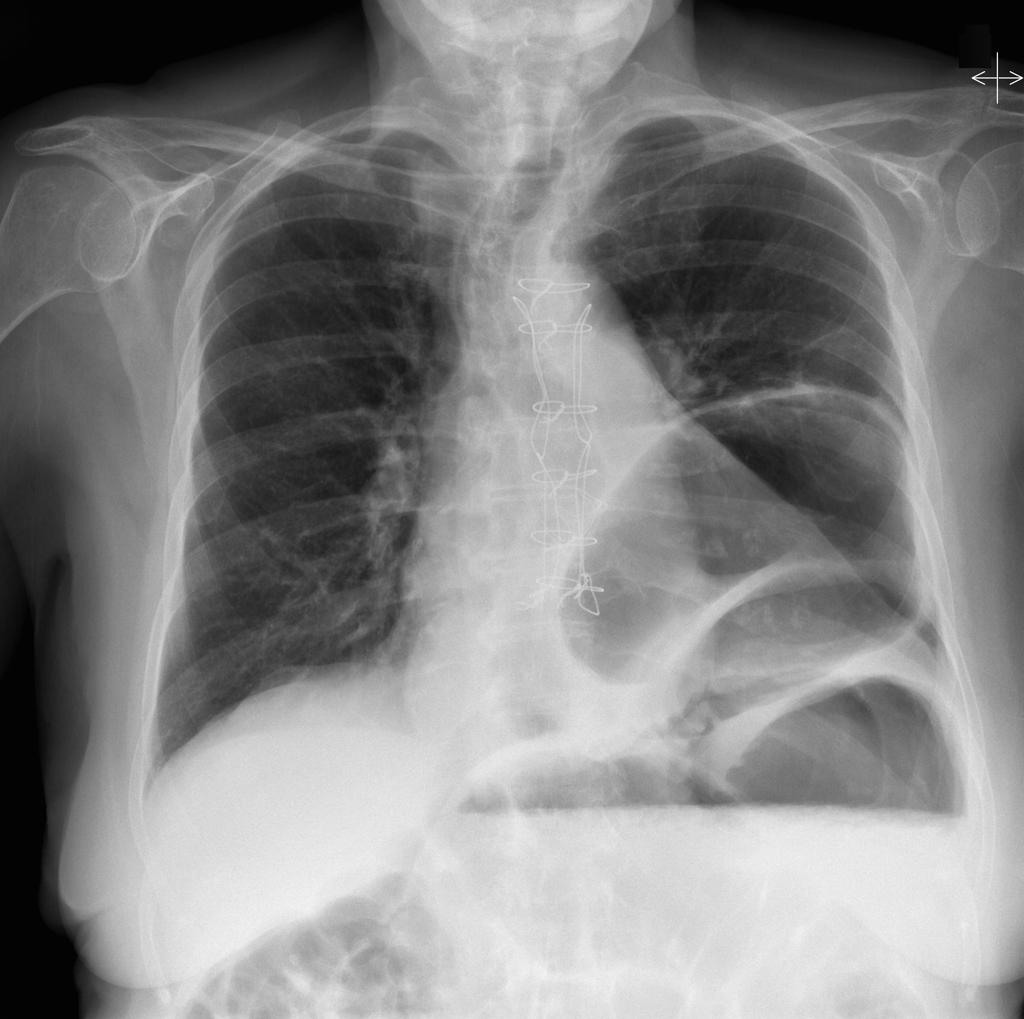 Paraesophageal Hernia With Gastric Volvulus