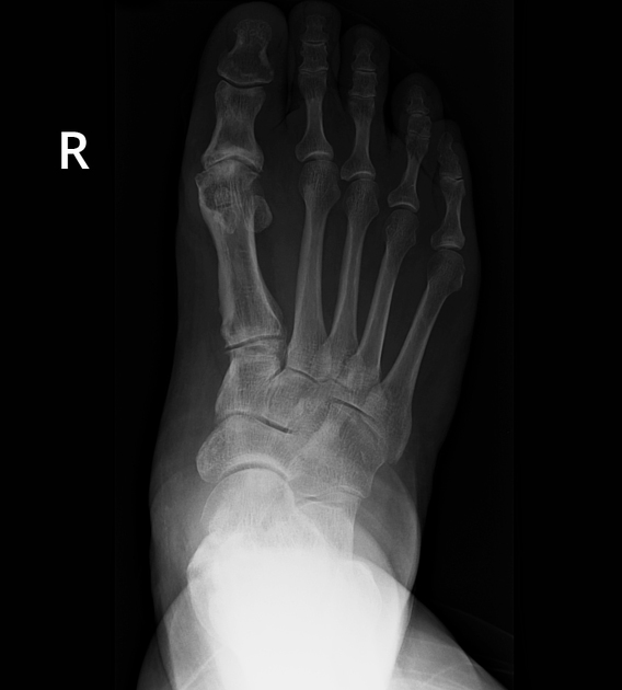 Polyostotic melorheostosis, Radiology Case