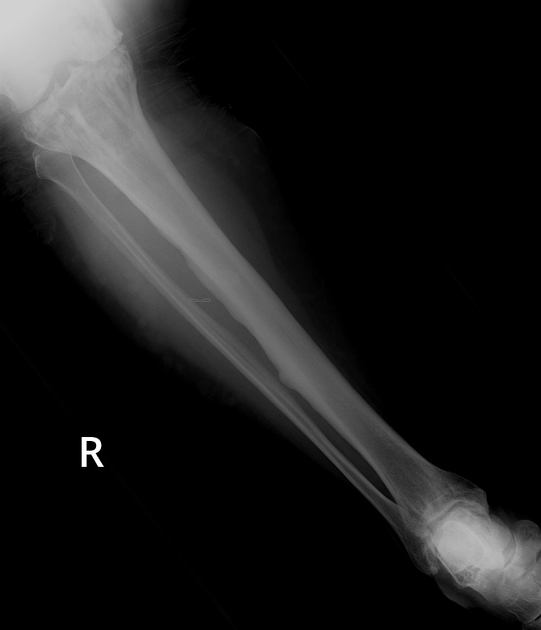 Dripping candle wax sign (melorheostosis), Radiology Reference Article