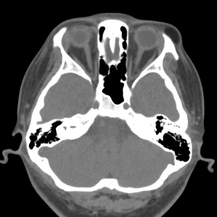 Orbital dermoid cyst | Radiology Reference Article | Radiopaedia.org