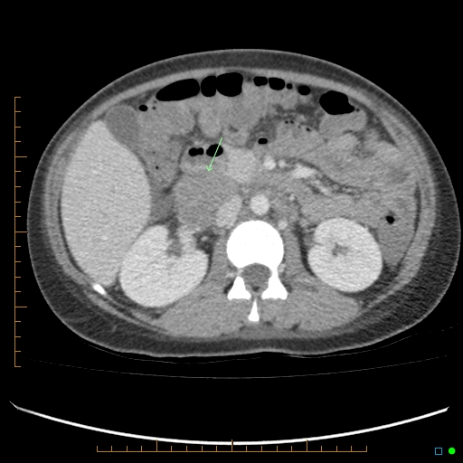 Post Partum Right Ovarian Vein Thrombosis Thrombophlebitis Image