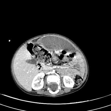 wandering spleen syndrome radiopaedia