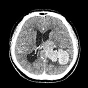 Intraventricular meningioma | Radiology Reference Article | Radiopaedia.org