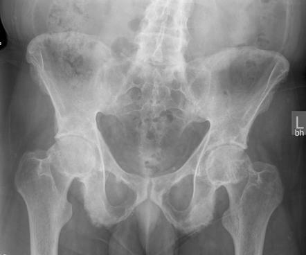 Ankylosing Spondylitis Pelvis X Ray