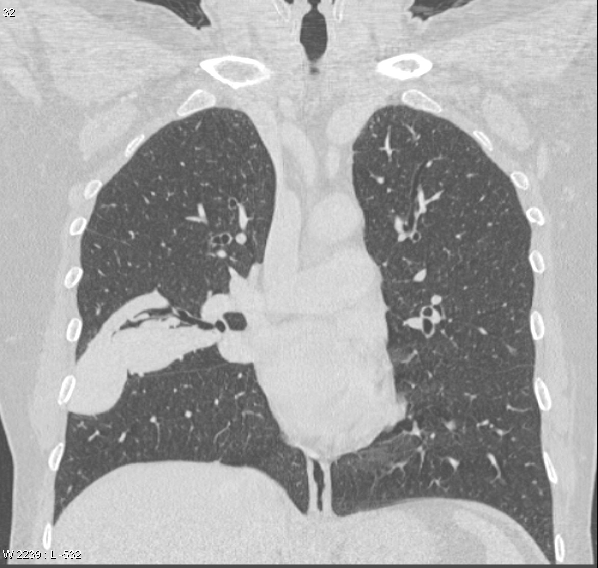 Мальформация легких кт. Pulmonary AVM CT. CT lung patterns. Легкие аса.