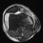 patellar subluxation mri