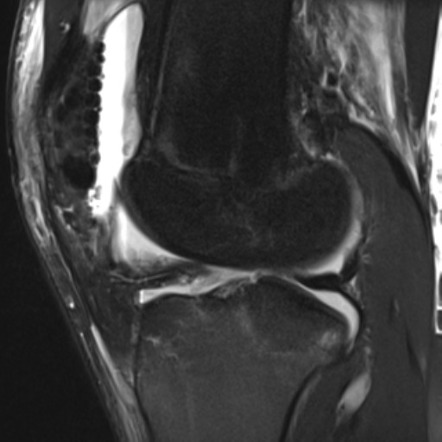 Medial femoral condyle fracture associated with lipohemarthrosis and ...