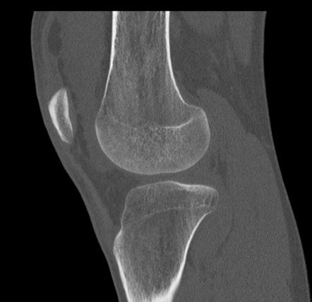 Medial femoral condyle fracture associated with lipohemarthrosis and ...