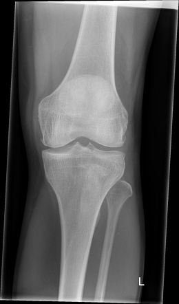 Longstanding Osgood-Schlatter disease | Radiology Case | Radiopaedia.org