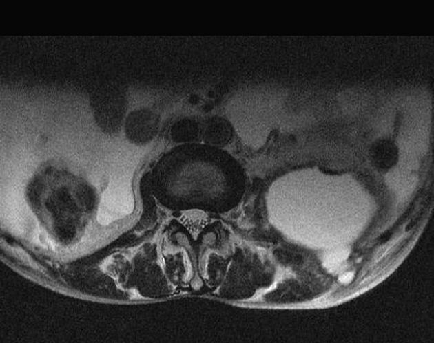 Abscess Radiology Reference Article Radiopaedia