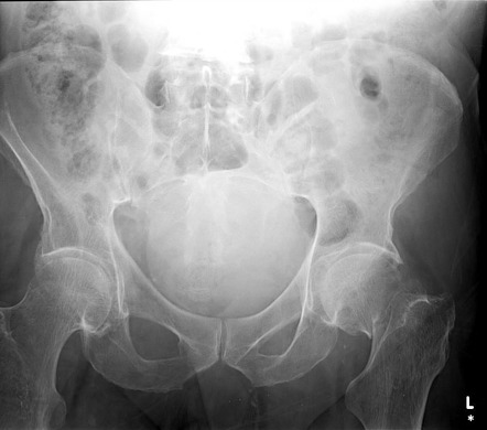 Neck of femur fracture and incidental lytic bone lesion | Radiology ...