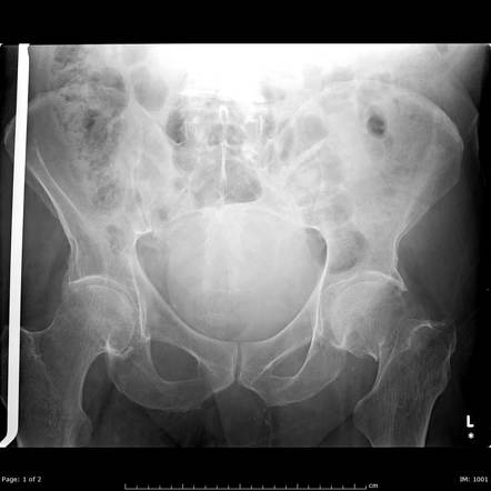 Neck of femur fracture and incidental lytic bone lesion | Radiology ...