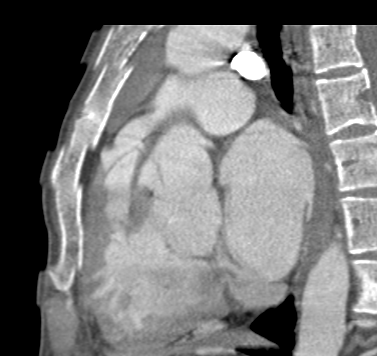 Pentalogy of Fallot | Image | Radiopaedia.org