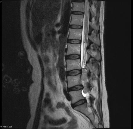 Cauda equina neuroendocrine tumor | Radiology Reference Article ...