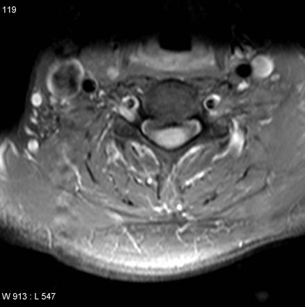 Spinal ependymoma | Image | Radiopaedia.org