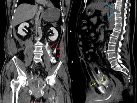 Vicarious contrast excretion | Image | Radiopaedia.org