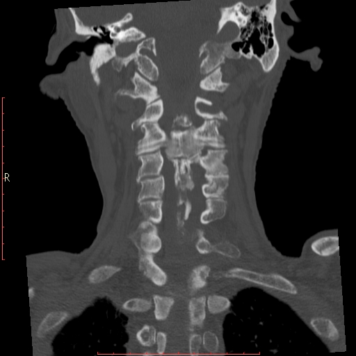 Diffuse idiopathic skeletal hyperostosis (DISH) | Image | Radiopaedia.org