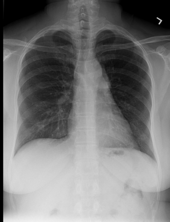 Thymoma | Radiology Case | Radiopaedia.org