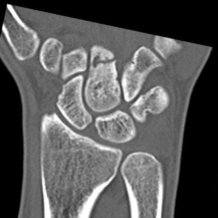 Isolated capitate fracture | Image | Radiopaedia.org