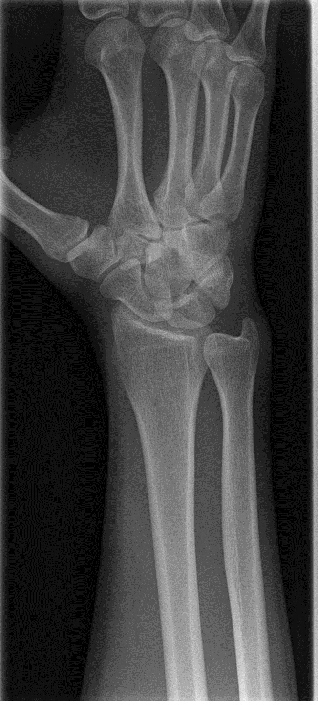 Isolated capitate fracture | Image | Radiopaedia.org