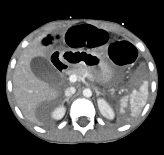 Splenic Trauma Radiology Reference Article