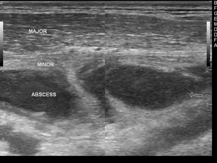 Pectoralis minor abscess | Image | Radiopaedia.org