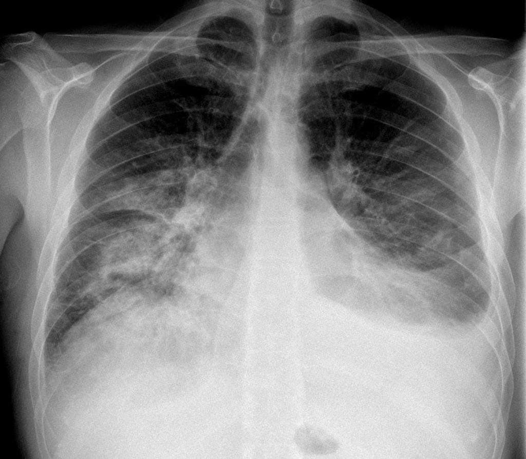 pulmonary edema chest x ray