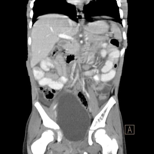 Pancreatic laceration | Image | Radiopaedia.org