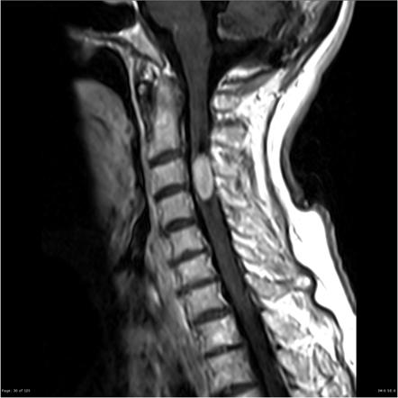 Spinal ependymoma | Radiology Reference Article | Radiopaedia.org