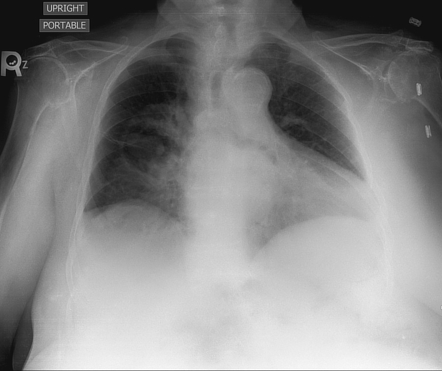 Morgagni hernia | Radiology Case | Radiopaedia.org