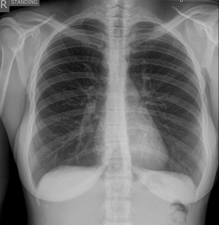 Right aortic arch | Radiology Case | Radiopaedia.org