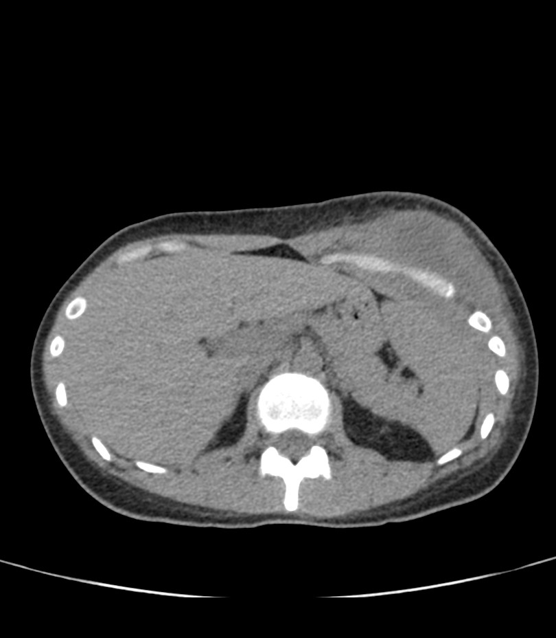 Empyema necessitans | Image | Radiopaedia.org