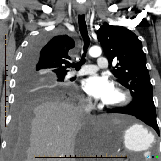 Pseudomyxoma Peritonei Et Pleuri - Appendiceal Mucinous Cystadenoma ...