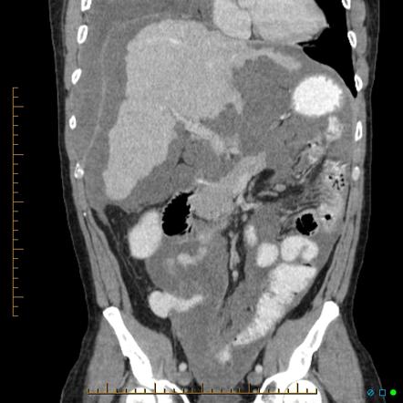 Pseudomyxoma peritonei et pleuri - appendiceal mucinous cystadenoma ...